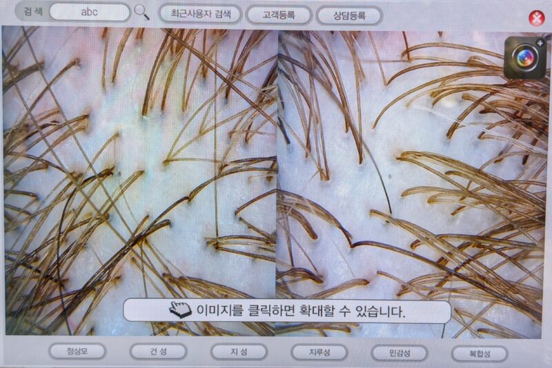 Close-up of hair follicles on a scalp displayed on a computer screen, with the interface showing Korean text and option buttons for analyzing different scalp conditions.